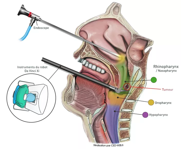 Chirurgie assistée par robot