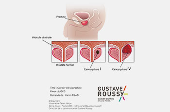 Illustartion, Pr Karim FIZAZI