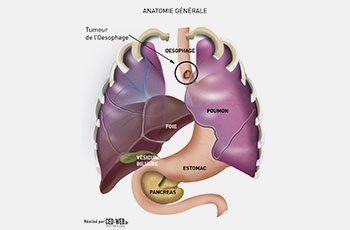 Chirurgie d'exérèse 