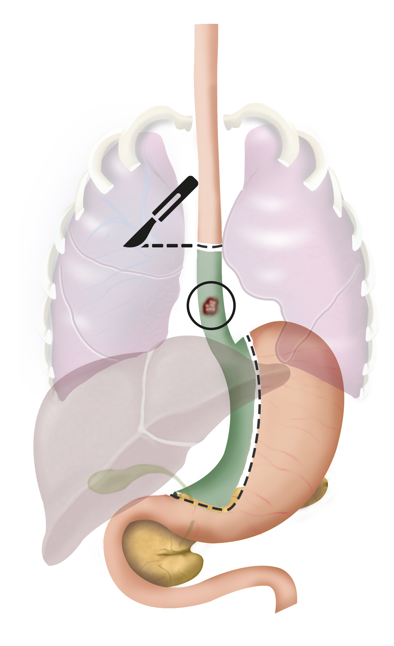 Gastrectomie partielle 2