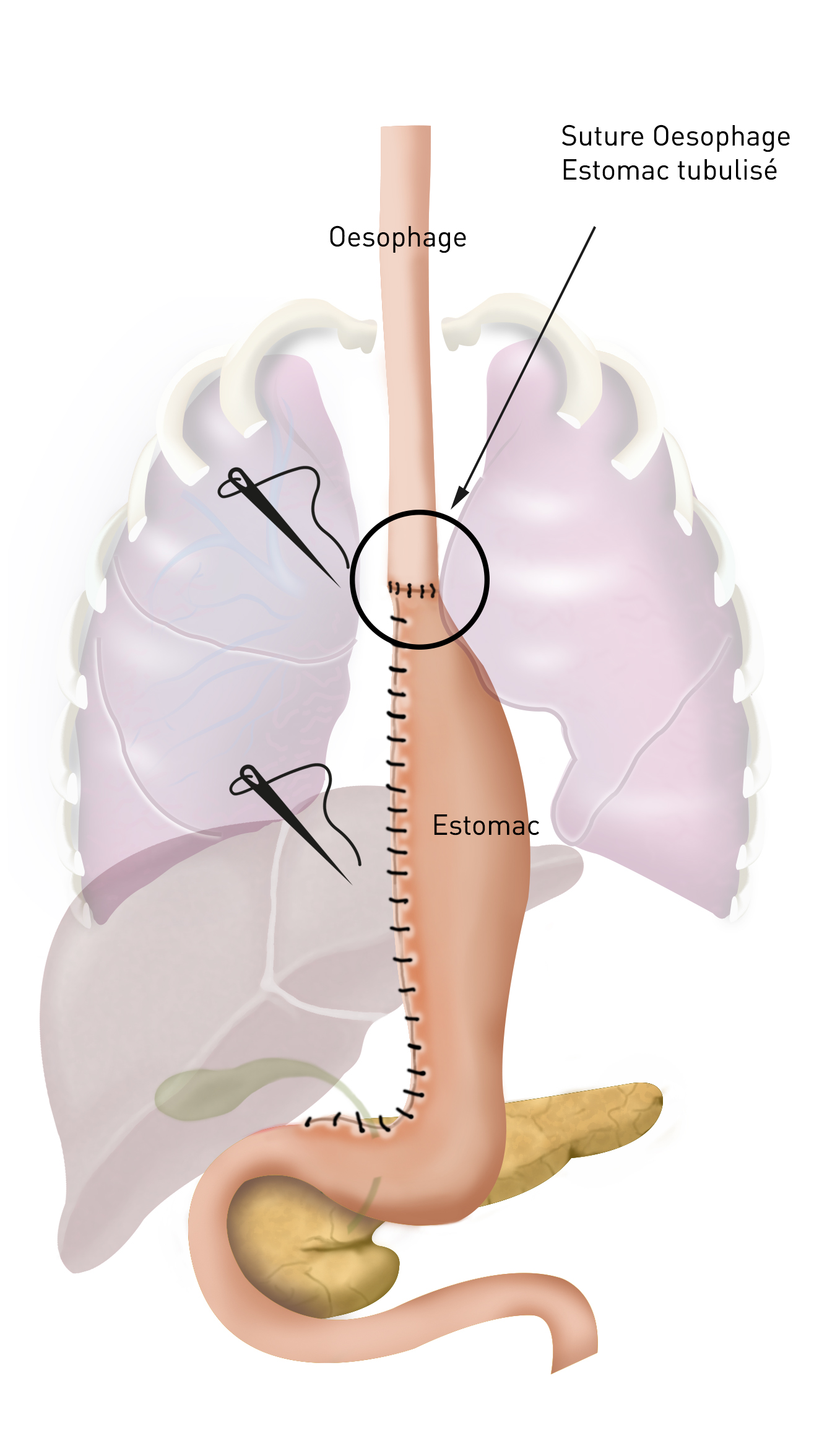 Gastrectomie partielle 3